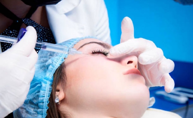 tiêm filler xoá nếp nhăn vùng mắt