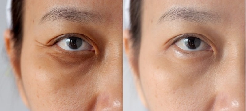 nếp nhăn vùng mắt