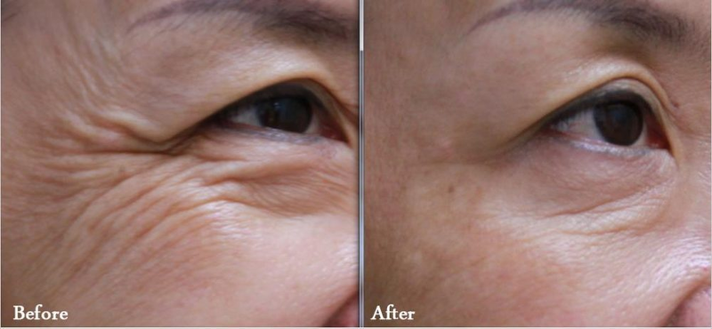 xoá nhăn vùng mắt