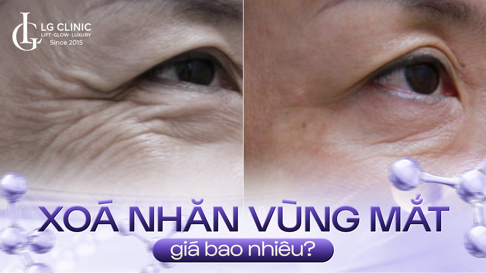 Xóa nhăn vùng mắt giá bao nhiêu?