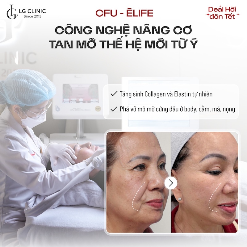 nâng cơ xoá rãnh cười tại lg clinic