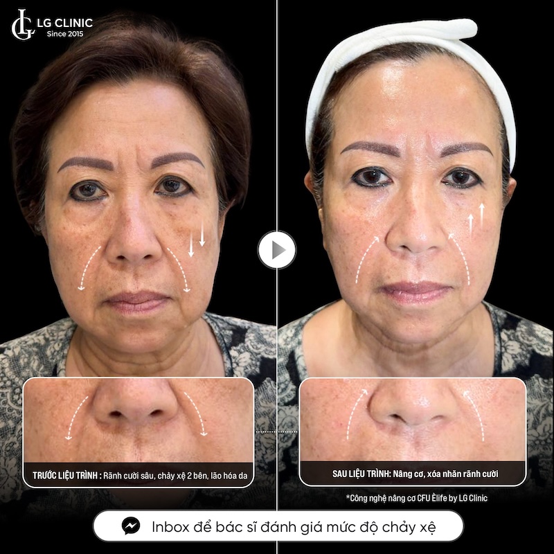 xoá rãnh cười tại lg clinic