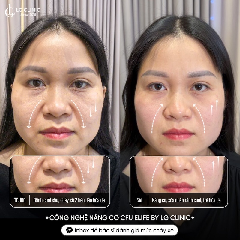 xoá rãnh cười tại lg clinic