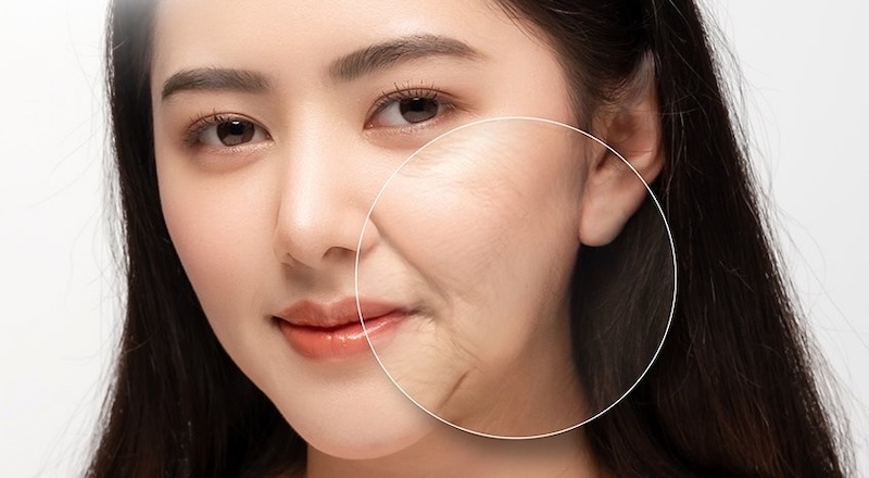 nếp nhăn rãnh cười