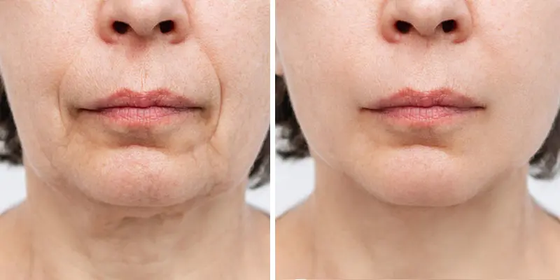 xoá rãnh cừoi giá bao nhiêu