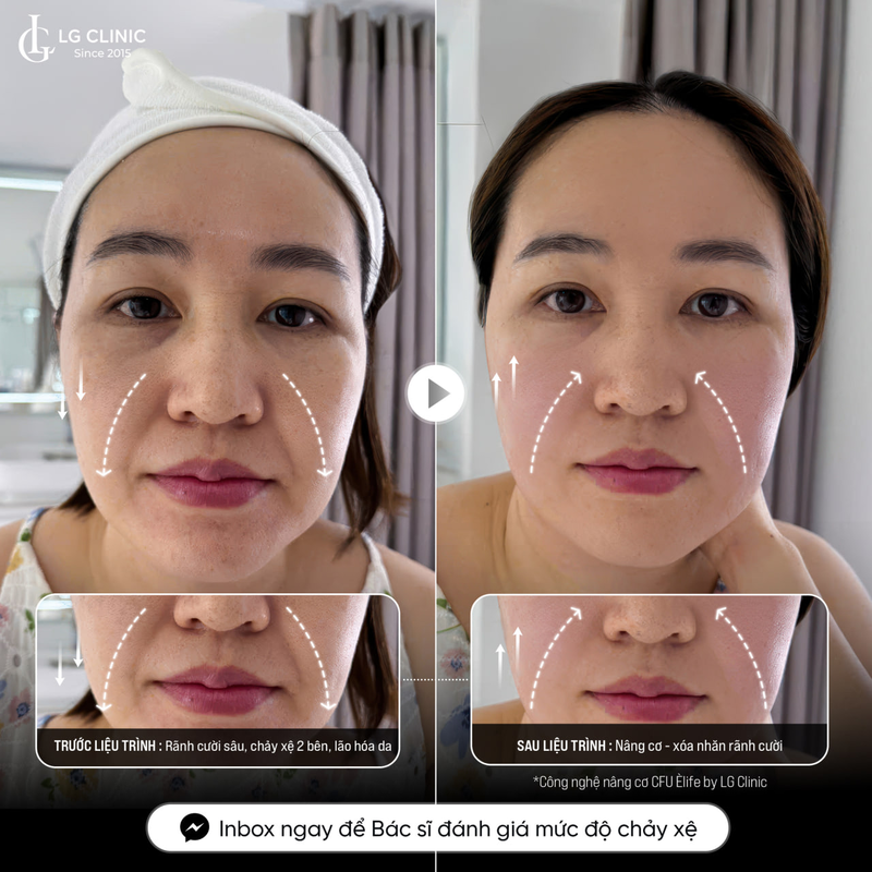 hình ảnh thực tế xoá rãnh cười