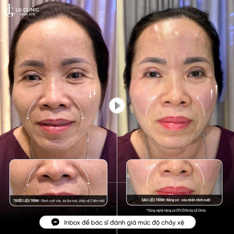 khách hàng xoá rãnh cừoi tại lg clinic