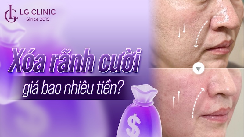 xóa rãnh cười giá bao nhiêu