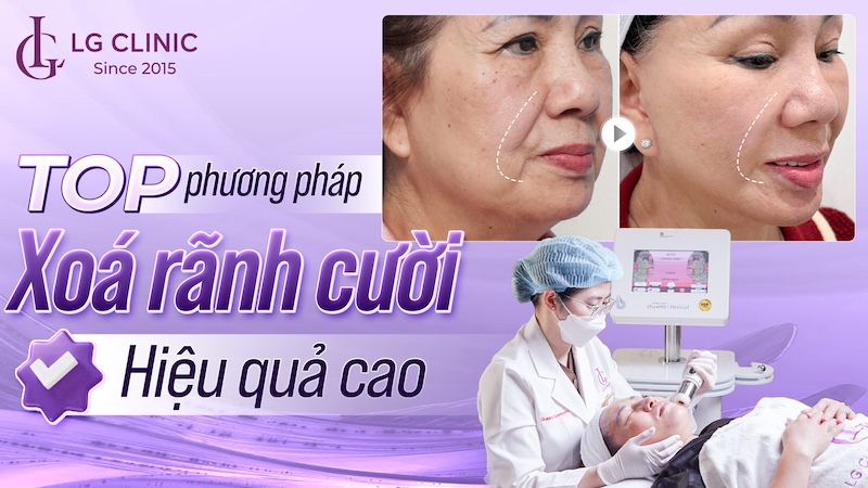 xoá rãnh cười