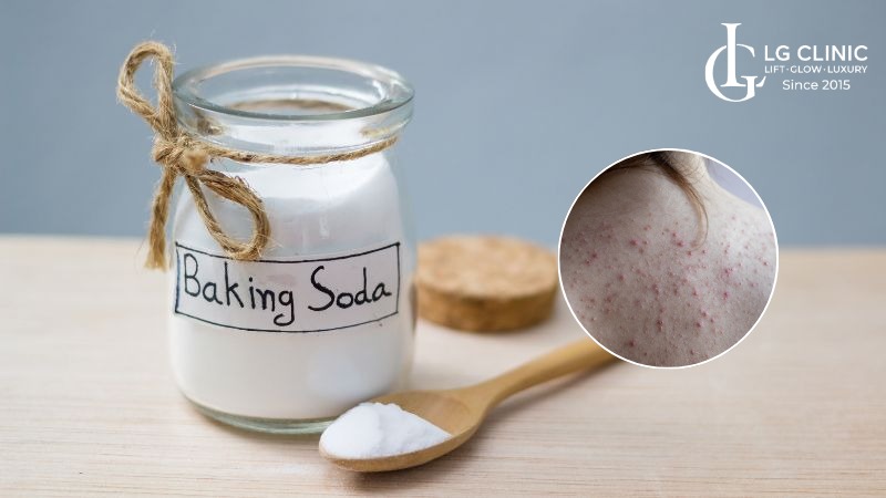 cách trị mụn lưng bằng baking soda