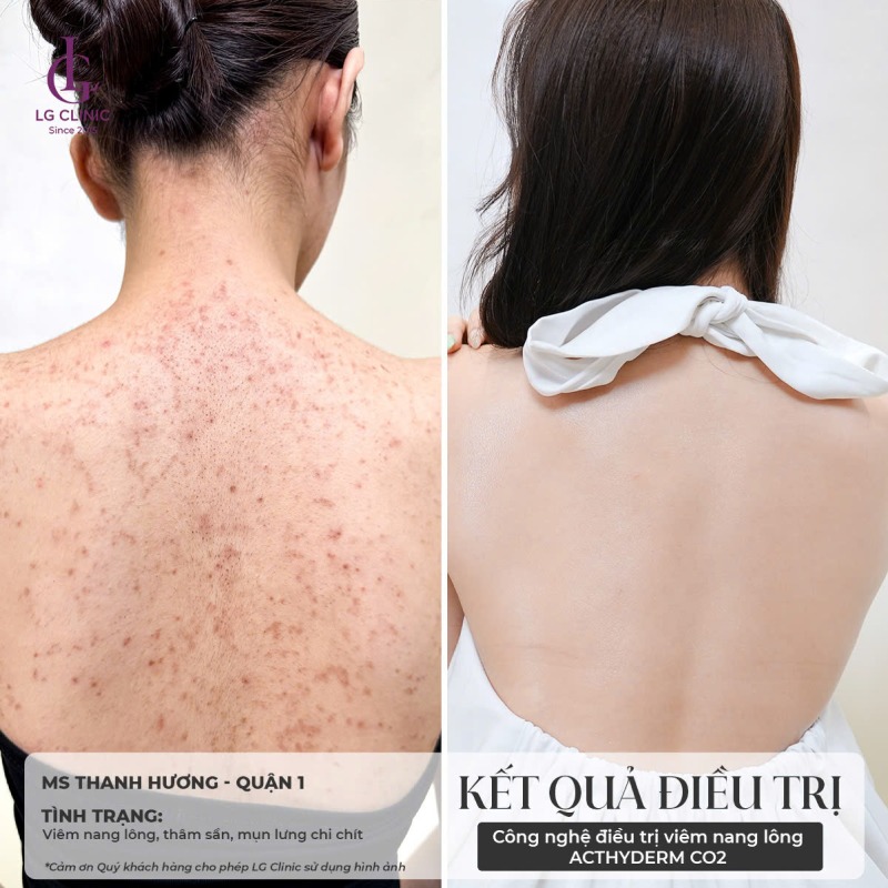 cách trị mụn lưng bằng baking soda