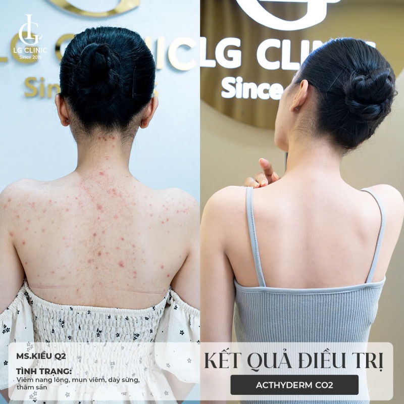 cách trị mụn lưng bằng baking soda