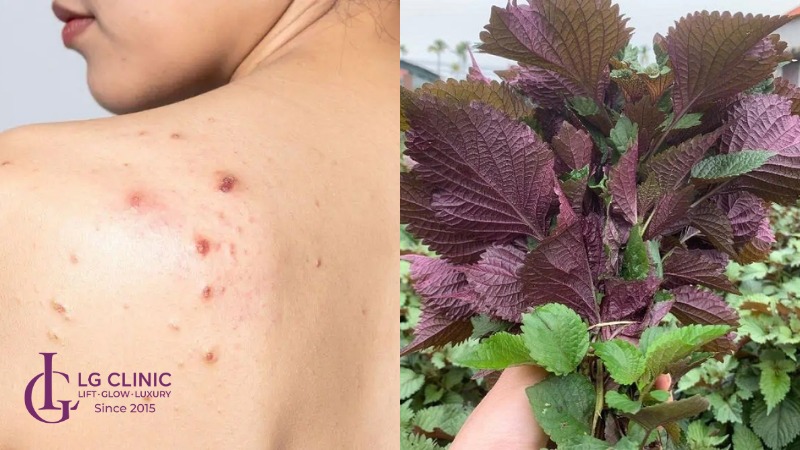 Cách trị mụn lưng bằng lá tía tô 