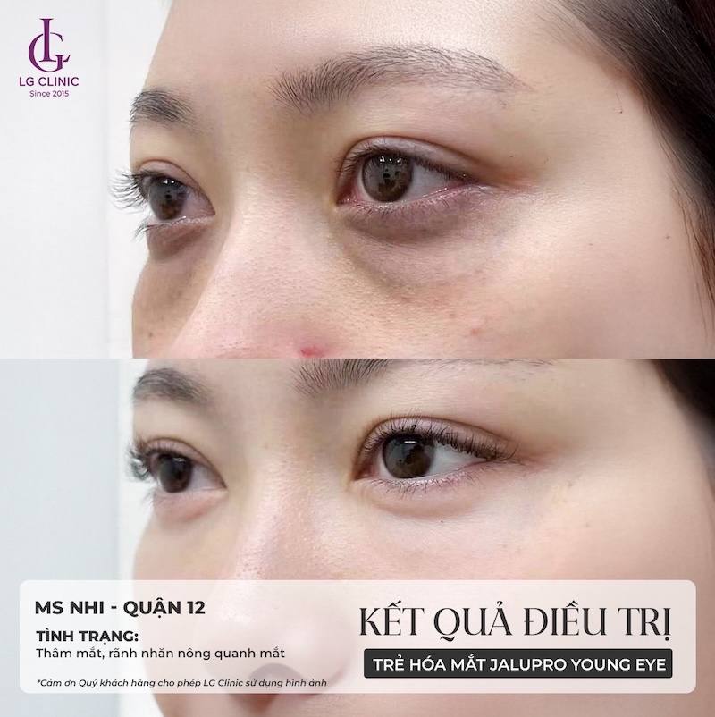 tiêm xoá nhăn vùng mắt