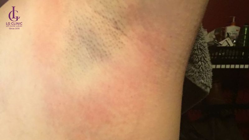 Có nên wax lông nách không