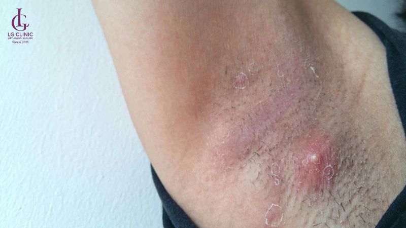 Có nên wax lông nách không