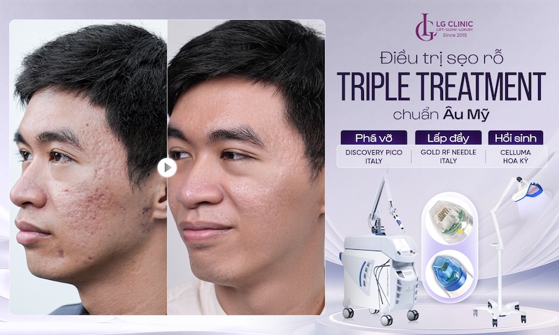 trị sẹo rỗ triple treatment