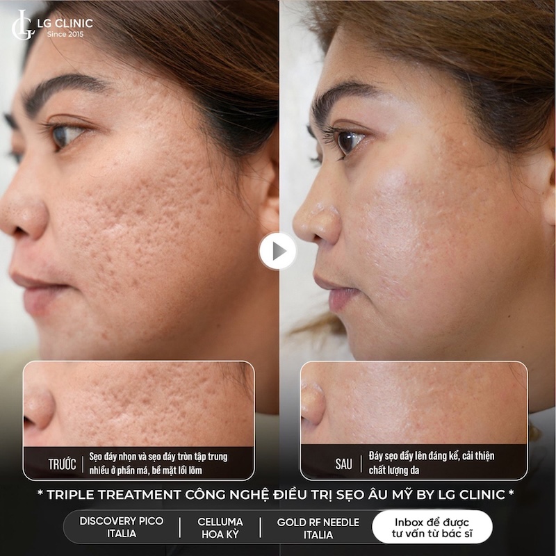 trị sẹo rỗ triple treatment