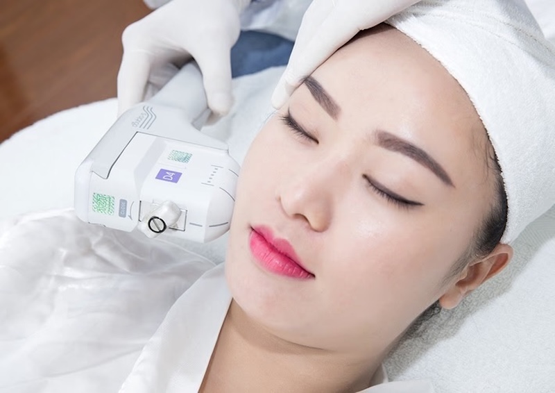 công nghệ xóa nếp nhăn hifu