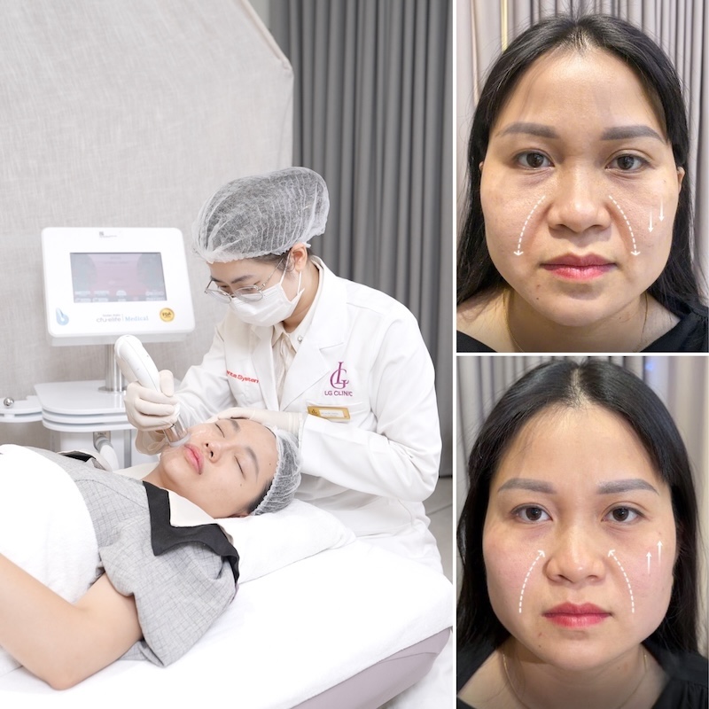 xoá nhăn rãnh cười bằng công nghệ CFU Èlife