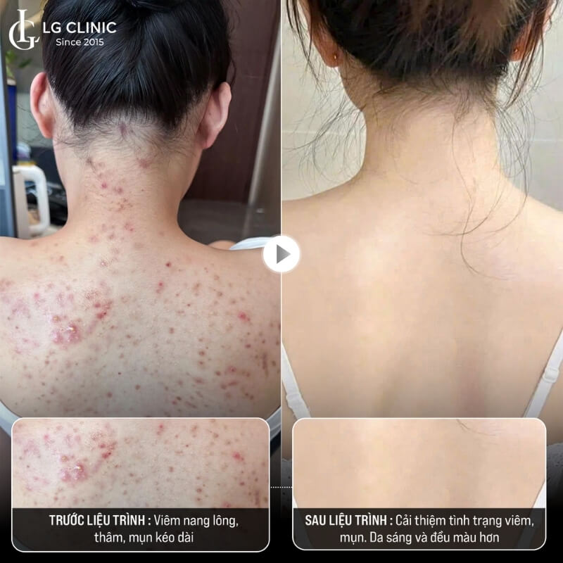 điều trị mụn lưng giá bao nhiêu