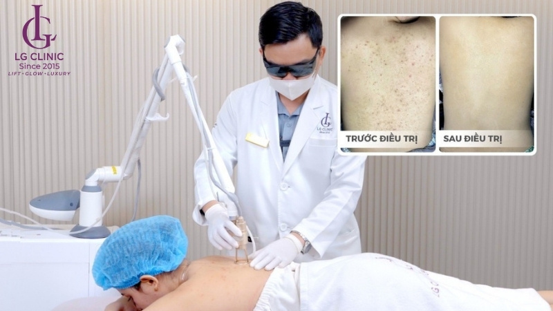 điều trị mụn lưng hiệu quả