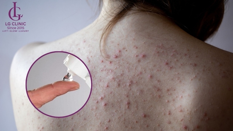 dùng thuốc bôi điều trị mụn lưng