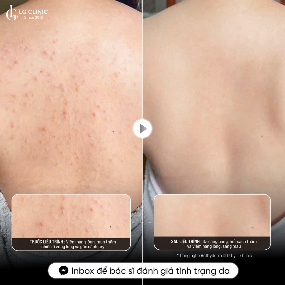 Hình ảnh khách hàng trị mụn lưng tại LG Clinic