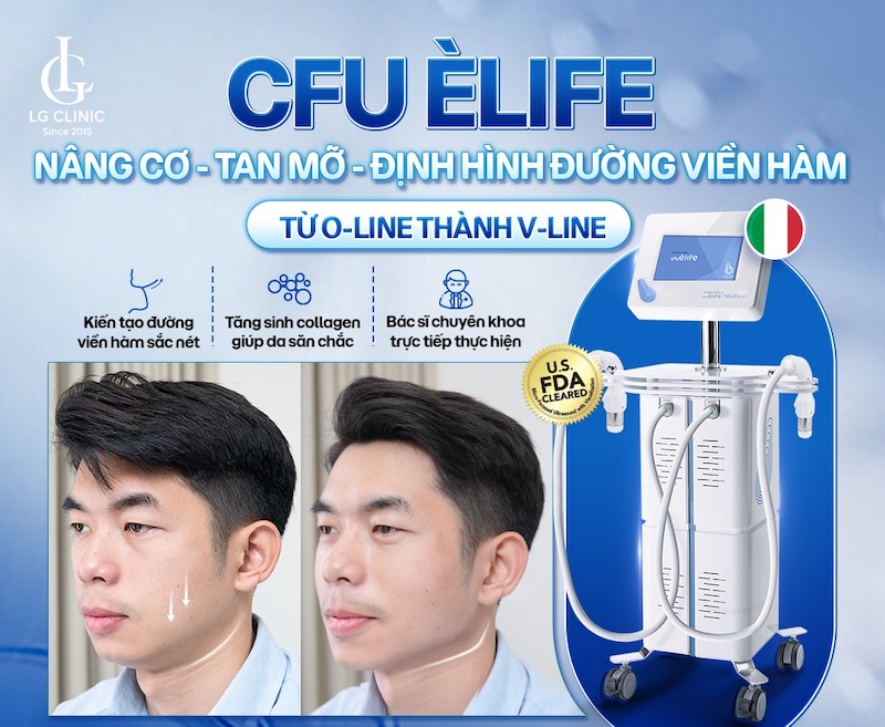 thon gọn viền hàm nam