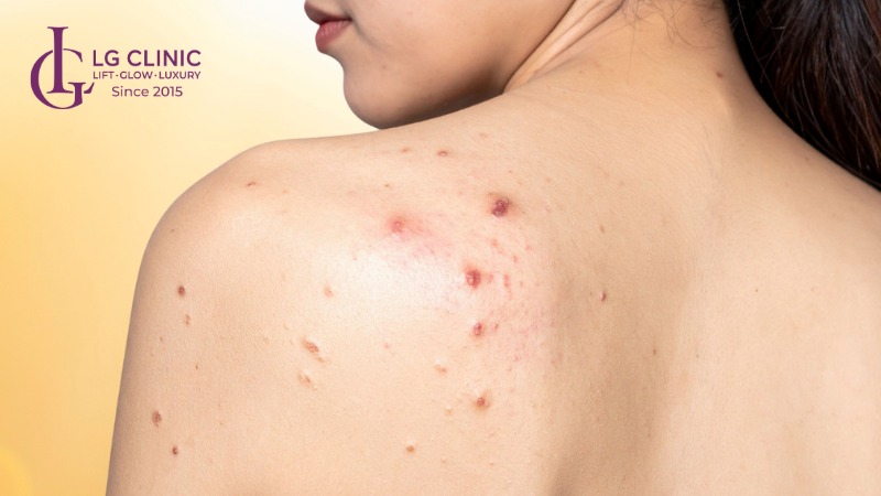 Hình ảnh mụn lưng