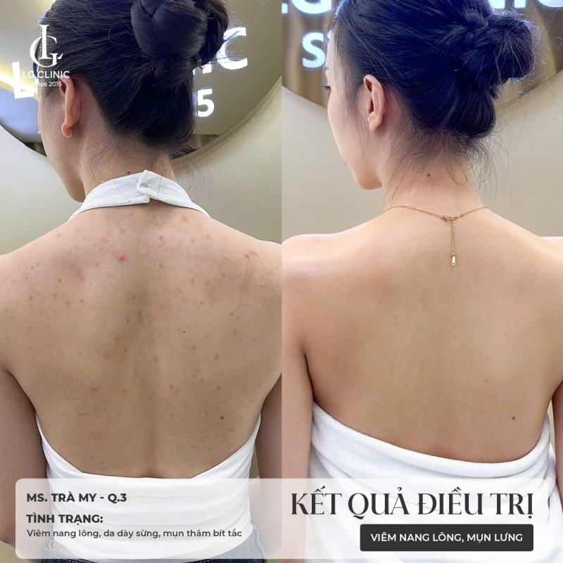 Hình ảnh mụn lưng