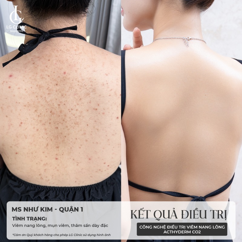 Hình ảnh mụn lưng