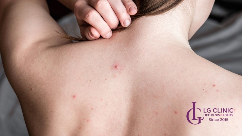 Hình ảnh mụn lưng