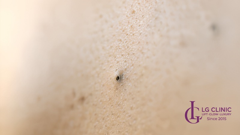 Hình ảnh mụn lưng