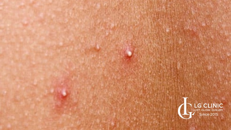 Hình ảnh mụn lưng