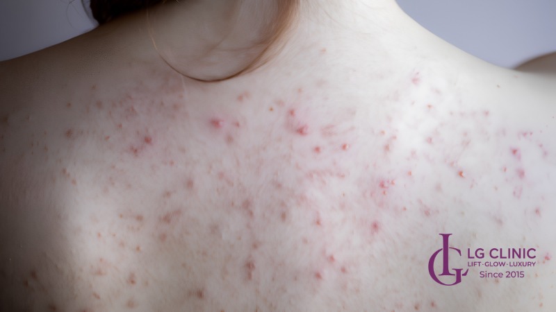 Hình ảnh mụn lưng