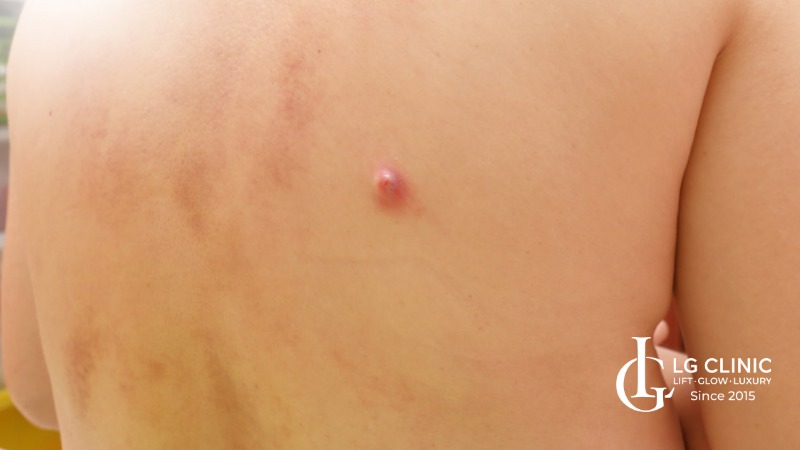 Hình ảnh mụn lưng