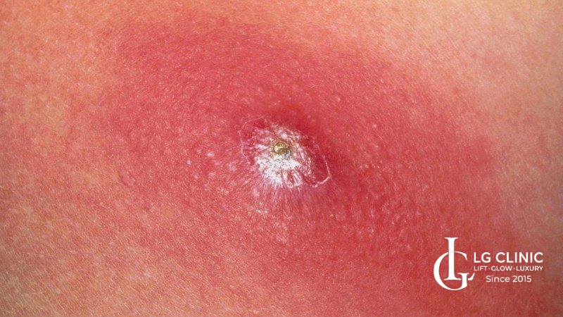 Hình ảnh mụn lưng