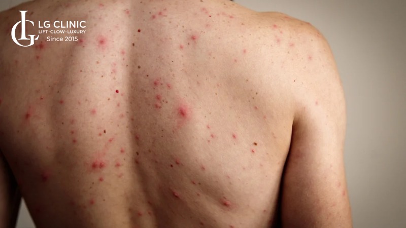 hình ảnh trị mụn lưng