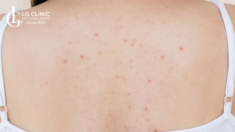 hình ảnh mụn lưng