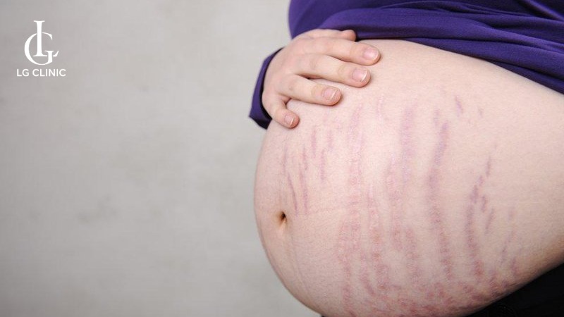 kem trị rạn da cho bà bầu