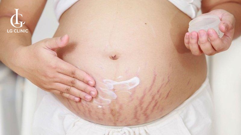 kem trị rạn da cho bà bầu