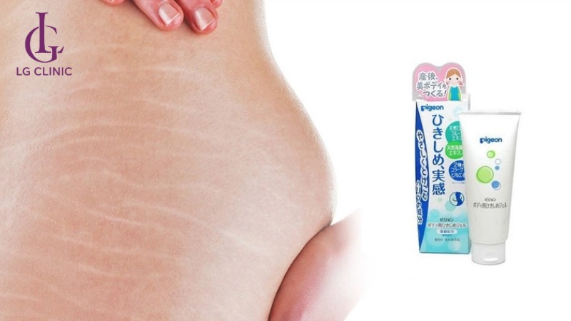 kem trị rạn da cho bà bầu