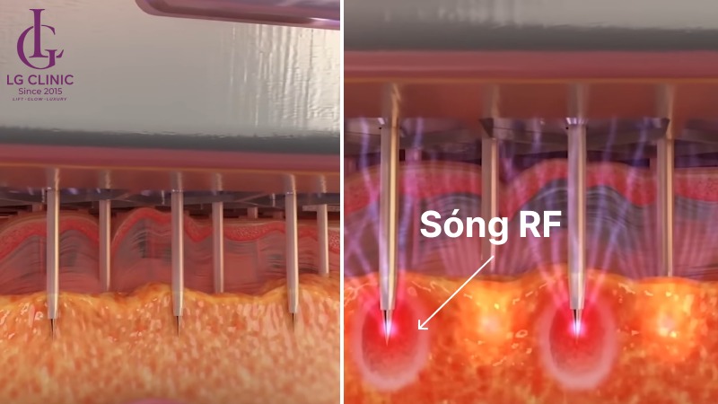 Làm sao để biết mình có bị hôi nách không