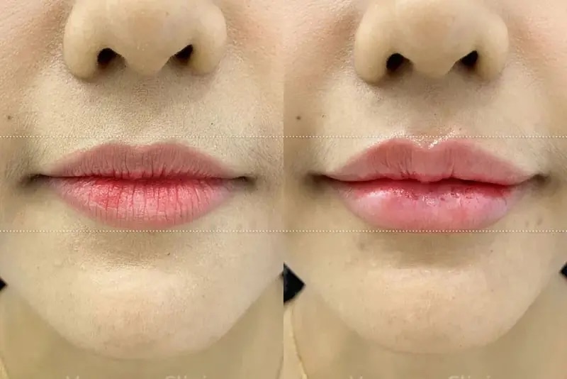 tiêm filler môi