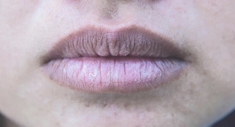 môi nhiều nếp nhăn