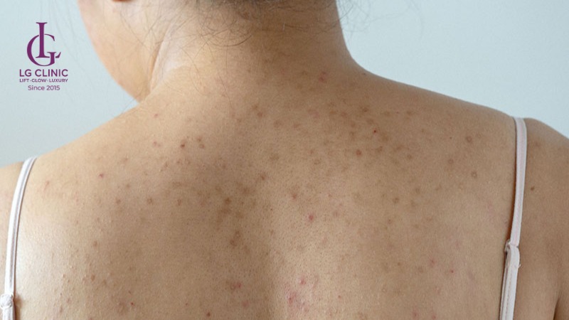 Mụn đầu đen ở lưng