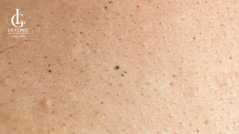 Mụn đầu đen ở lưng