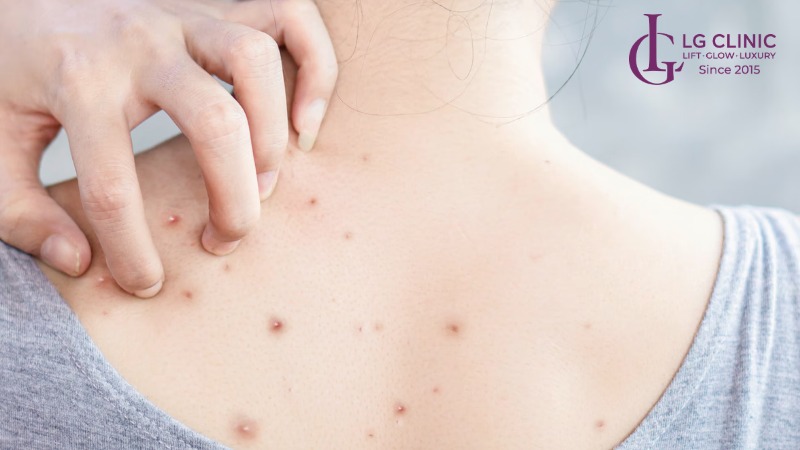 Mụn đầu đen ở lưng