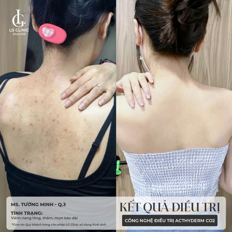 Mụn đầu đen ở lưng